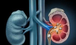 Agar Ginjalmu Sehat,  Ini 8 Musuh Utama yang Harus Dihindari